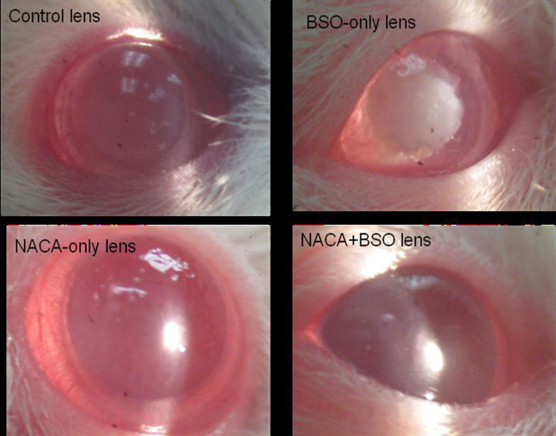 Cataracts-web.jpg