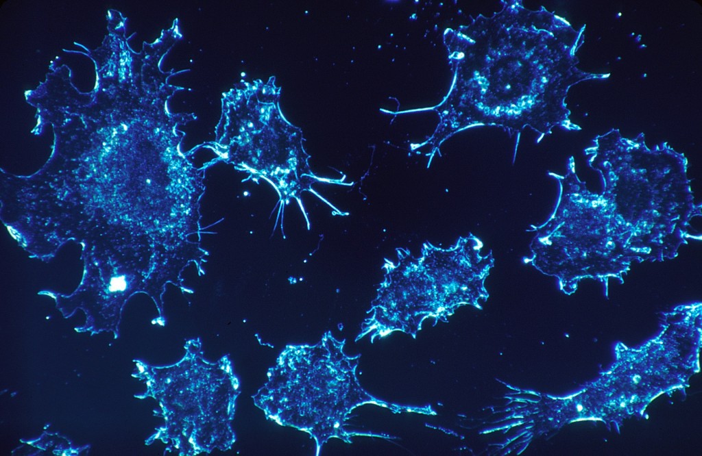 An electron microscope image of cancer cells. (Pixabay.com image.)